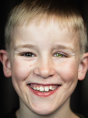 Dette er Fredrik. Han fikk kreft som barn. Fått øyeprotese med Bodø/Glimt. TIFOen bør hylles. Det samme bør Fredrik. Doner gjerne en slant til kreft om du har muligheter