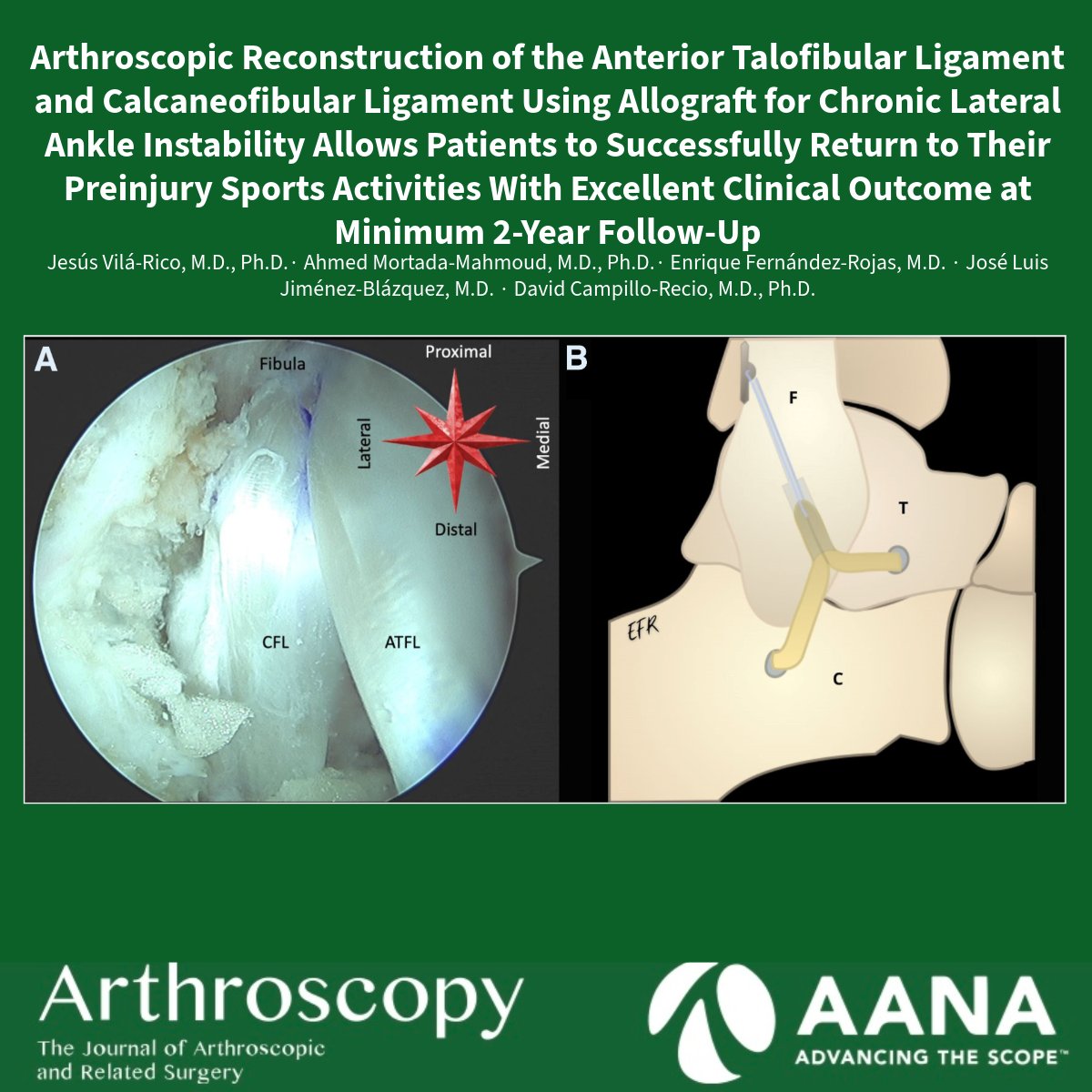 ArthroscopyJ's tweet photo. Patients with chronic lateral ankle instability treated with arthroscopic ATFL &amp; CFL allograft reconstruction:
▫️ Return to work ~3 months
▫️ Return to sports ~6 months
▫️ 100% achieved meaningful clinical improvement
Minor complications: 9%
👉 Excellent 2-year outcomes! https://t.co/bHRPKZEsYK