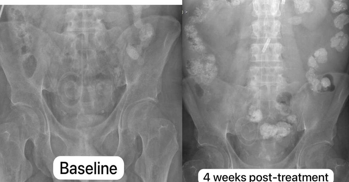sofia_gambetta's tweet photo. 38M with ESRD on peritoneal dialysis
🩻 Radiodense material in the bowel
Barium? 🤔 Nope! ❌
In this context → 💡 Fosrenol (Lanthanum carbonate) ⏩ strongly absorbs x-rays, highly radiopaque, mimicking contrast on X-rays
Case courtesy of @YashantAswani
#radres #bodyrad https://t.co/MEobxoiQx3