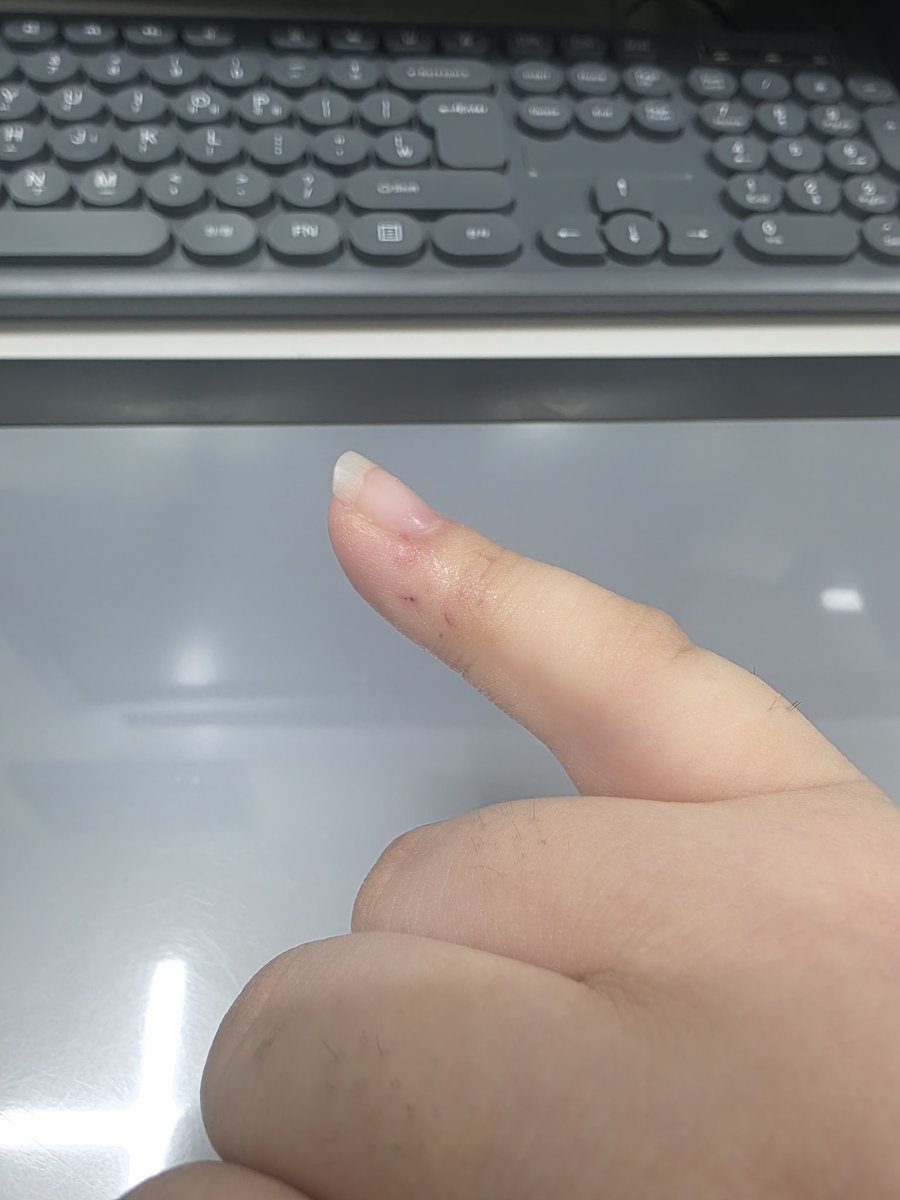 moveo_se's tweet photo. 어젯밤 사육장 청소하는데 푸딩이가 내 새끼손가락 물고 안놔줬음ㅠ 렛스네이크 같은 애들이 물면 찍찍이 느낌인데 볼파가 무니까 무섭 ㅠ 얼굴에 물뿌리고 다 했는데 안놔줘서 동생이 도와줌. 비누빡빡+소독+연고했더니 붓지도 않고 감염은 없는듯.. 벌써 푸딩이한테 2번째 물리구ㅠㅠ 밥은 또 안먹어 https://t.co/aIU6uAeNOq