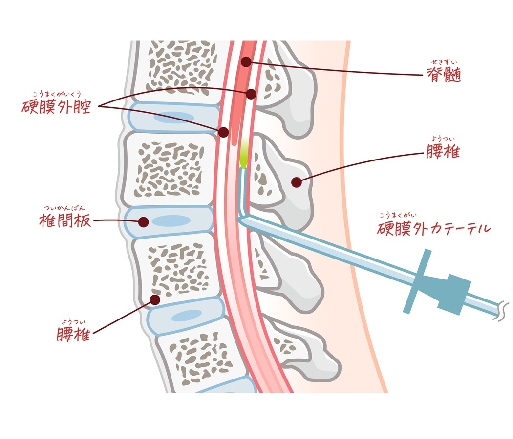 ”無痛分娩”は、陣痛の痛みを局所麻酔によってやわらげること。
当センターでは、陣痛が始まって、妊婦さんが麻酔を希望されるタイミングで、
産科医または助産師が診察を行い、お母さんと赤ちゃんに安全なタイミングであると確認できたら麻酔科医が麻酔を開始します。
ncchd.go.jp/hospital/pregn…