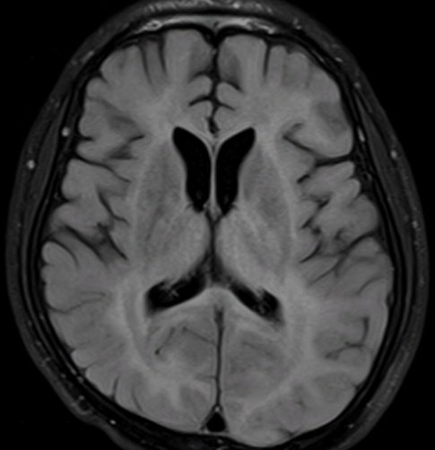 🧵 Spin Tweetorial Wednesday: Subacute Sclerosing Panencephalitis (SSPE)

✨ A forgotten yet fatal sequela of measles — let’s unpack its journey from virus to voxel.
