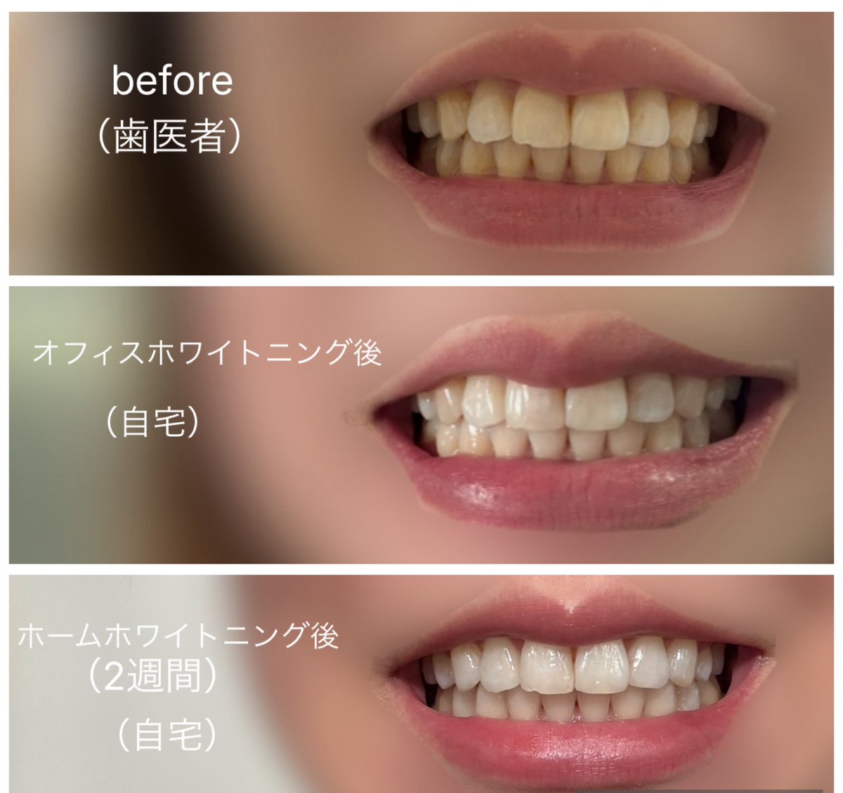 mi_kyousei's tweet photo. ホワイトニング終了したのでレポ🦷
オフィスホワイトニング１回→2週間ホームホワイトニングの流れだったんだけど予想よりかなり効果は実感できた✨
当たり前だけど気休めのホワイトニング歯磨き粉使うのとは訳が違うなと。beforeひどいよ🫠
（3枚ともiPhone内カメ無加工、撮影環境は多少異なります） https://t.co/zfuZl1NsGv