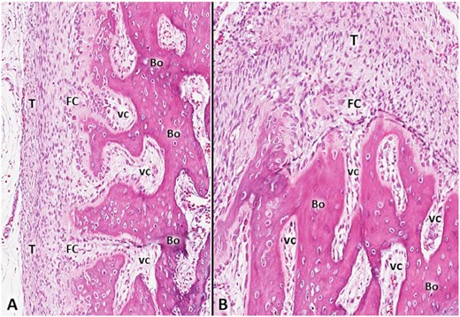 Rheumatology's tweet photo. Advances in knowledge
Just published by @riccivincenzo17
Ultrasound imaging/guidance for insertional Achilles tendinopathy
FREE PDF
https://t.co/siw9WwM4WW
Recent advances in ultrasound equipment allow for accurate assessment of the TBJ of the AT. The present observational study defined 5 elementary sonographic lesions of the IAT as bone spur, calcified longitudinal fissuration, intra-tendinous bony formation, tendon-bone disjunction, and fibrocartilage hyperemia. Pertinent ultrasound-guided procedures targeting the TBJ are also discussed.