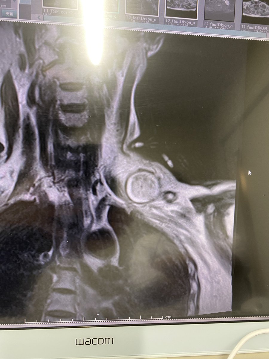 病院行ってきました！首の腫瘍は1ミリも変わりなくこのまま温存。多分死ぬまでわたしと一緒。なんの役にも立たないけど悪さも不倫もしないので元夫よりはましなパートナーです笑