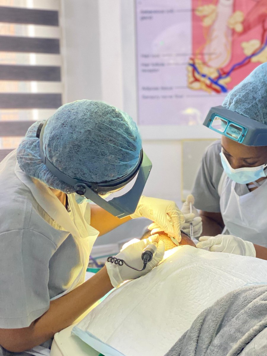 The donor hair used in a transplant is genetically resistant to balding. That’s why transplanted hair is permanent.