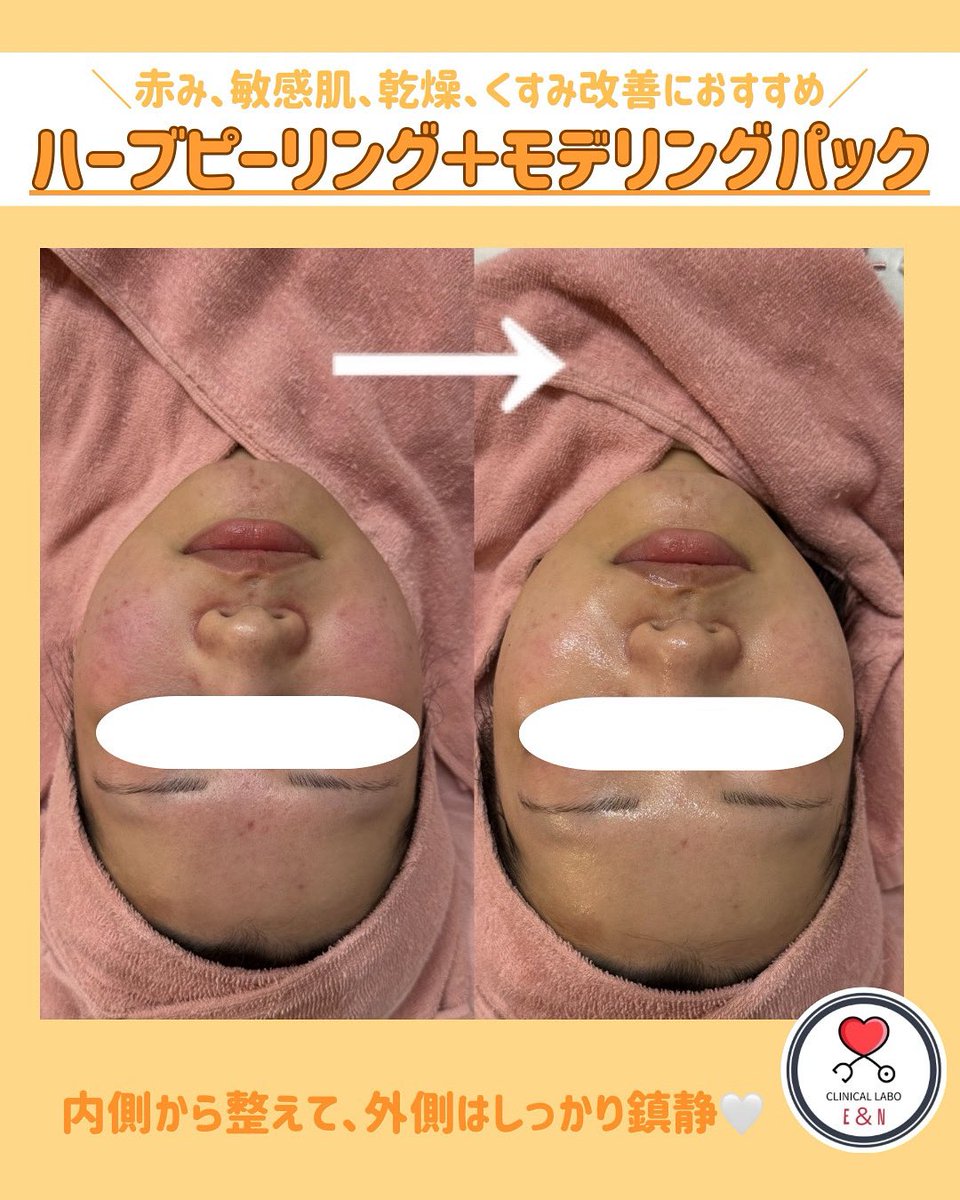 ハーブピーリングbeauty page1 Amazon.co.jp: 【角質オフ×美肌ケア】ハーブピーリング セルフ