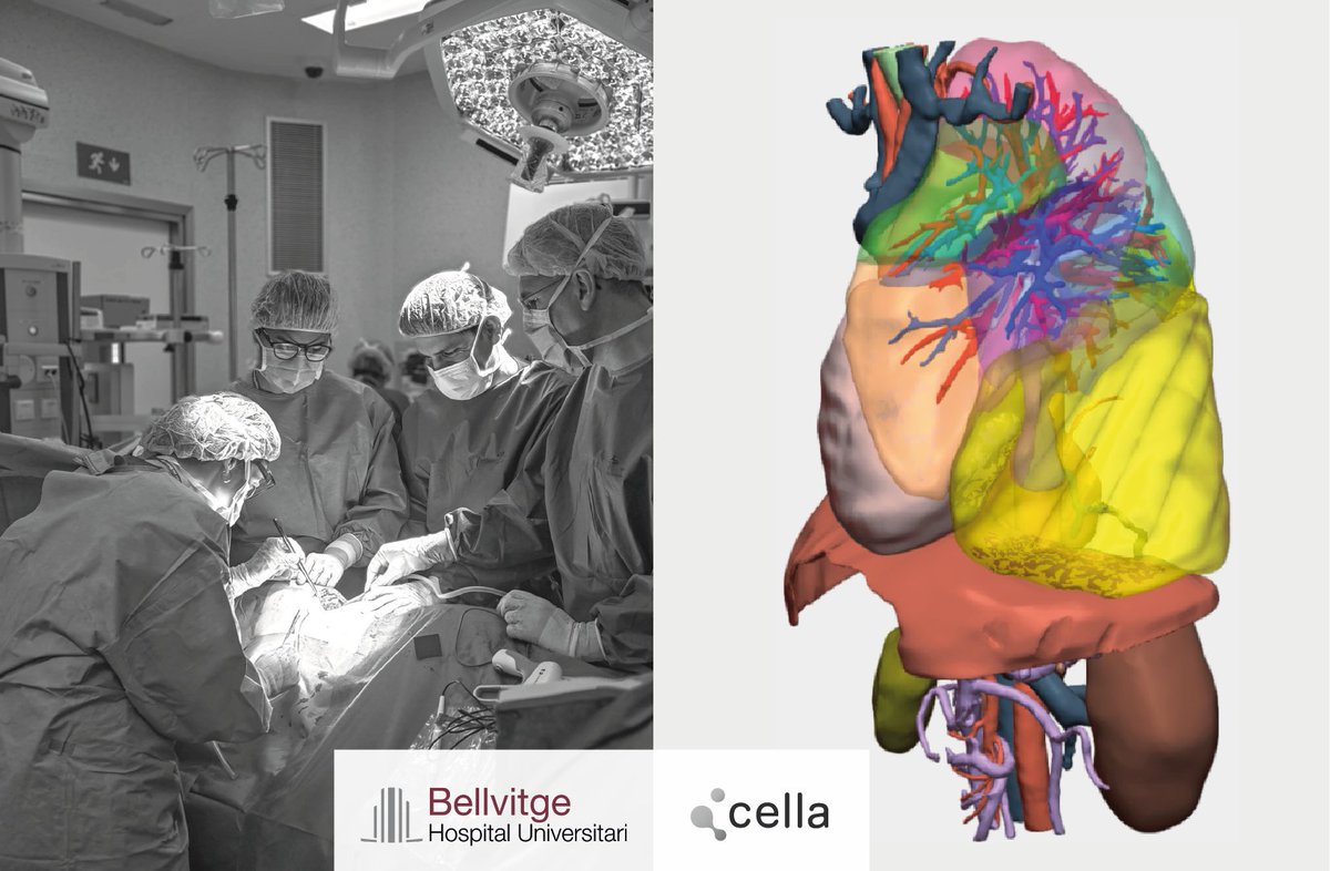 CellaMedical3D's tweet photo. 🔝 El @hbellvitge lleva a cabo con éxito una cirugía de un infrecuente tumor mesenquimal gigante, apoyando la planificación con un #modelo3D.

La paciente presentaba una masa de gran tamaño e hiper vascularizada, amentando la complejidad del procedimiento: https://t.co/HFCI2kX6mb https://t.co/xCl9APFVsk