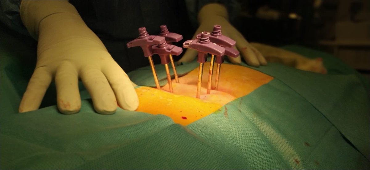 ⏺️ Desde 2015 el equipo de #neurocirugía de <a href="/Neuro_Iensa/">Instituto de Especialidades Neurológicas (IENSA)</a> ha realizado más de 350 #vertebroplastias,  técnica utilizada para reforzar el hueso y reducir el dolor de fractura vertebral. Para ello, se introduce cemento (Polimetacrilato) bajo sedación ligera o anestesia general.