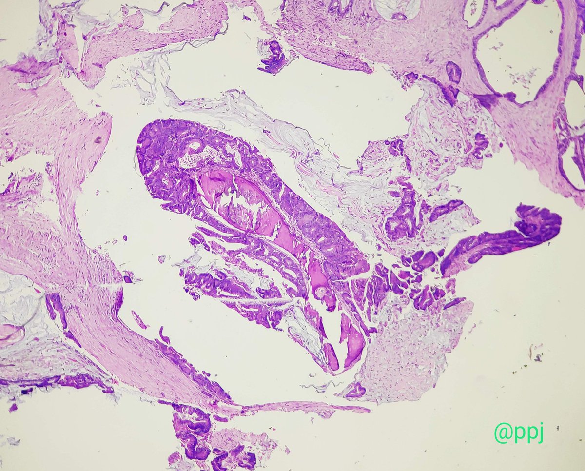 padmapathology1's tweet photo. Osseous metaplasia in colonic adenocarcinoma
#GIpath
#SmallLittleThings
#PathTwitter
#PathResidents https://t.co/IYYsomNLc5