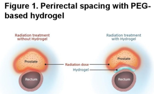 urotoday's tweet photo. Pre-formed radiopaque hydrogel for perirectal spacing in subjects with low to intermediate-risk #ProstateCancer undergoing external beam radiotherapy (EBRT): a multicenter, randomized, controlled clinical study #HYDROSPACE. Presentation by @BrianBaumannMD @SpfldClinic. #ASTRO25 written coverage by @chavarriagaj @UofT > https://t.co/6RtOnCIDZt @ASTRO_org