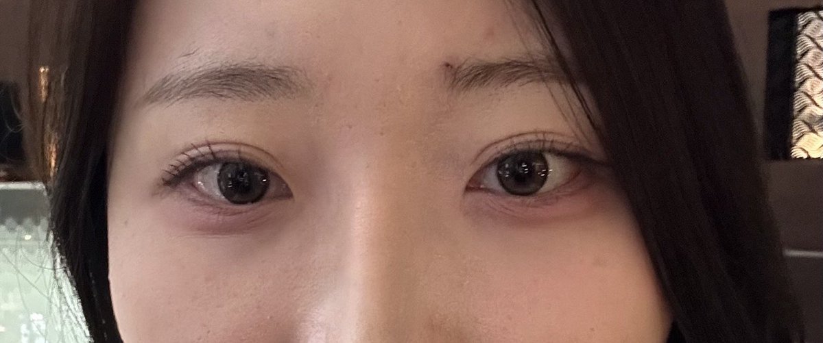 milkychan_____2's tweet photo. 6ヶ月検診行ってきた！！ボヤけてた二重線がくっきりして本当に褒められる🥹目頭もグラマラスもいい感じ🥰wom の髙田先生にお願いして良かったです😭💖 https://t.co/vbMDuX4WYw