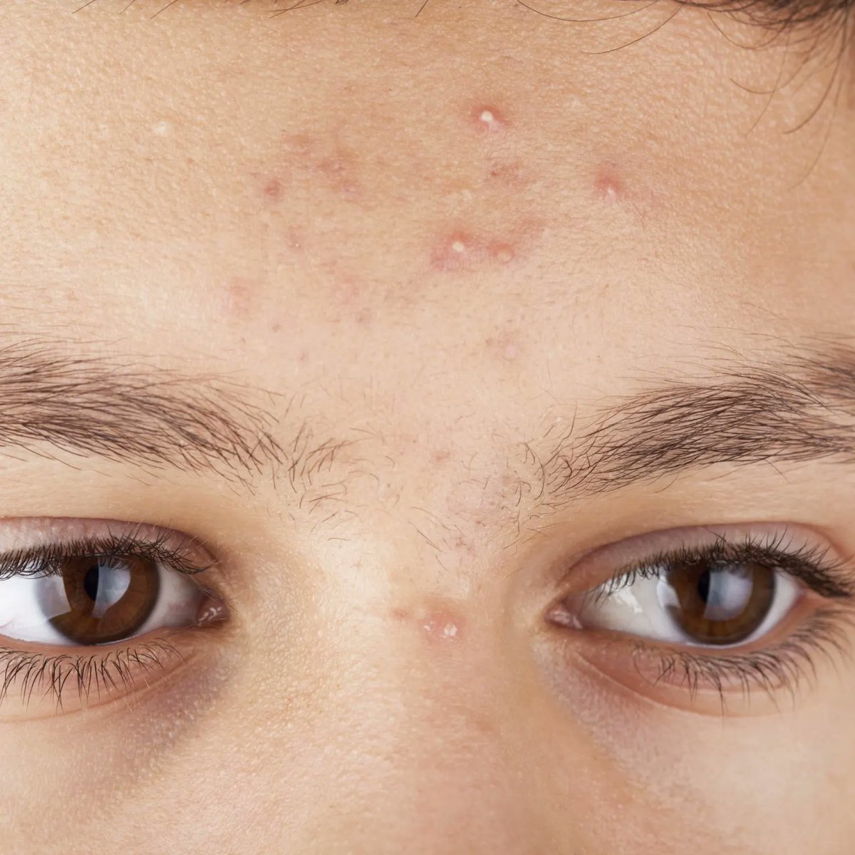 Cymbiotics38458's tweet image. Acne isn’t just teenage drama, it's molecularly complex. Multi-omics is revealing how genes, proteins, and metabolites drive the disease, paving the way for truly personalized treatments. 
Read more: tinyurl.com/5b389cbj
#Acne #PrecisionMedicine #DermResearch