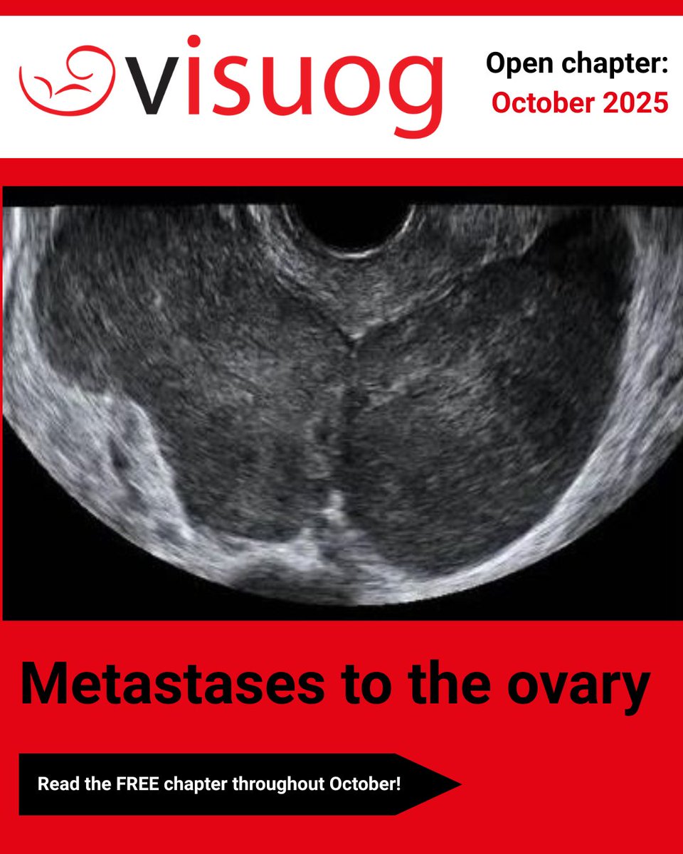 ISUOG's tweet photo. 📖 VISUOG open chapter October 2025

This month's FREE educational chapter is 'Metastases to the ovary', a topic that will be covered in the upcoming #ISUOGEducation course, Assessment of adnexal masses using ultrasound as part of session four: Malignancies, rare tumours, led by Prof. Lil Valentin. 

Read the chapter now: https://t.co/KnkmLhgreN

Register for our upcoming course to further expand your knowledge: https://t.co/uv0S2gIHQU

#LoveUltrasound