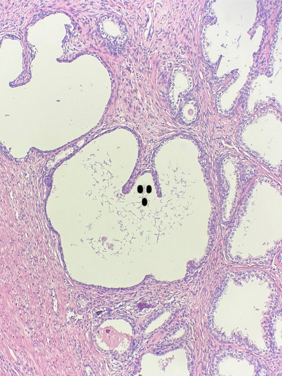 HAPPY SPOOKY SEASON! Boo from me and this prostate gland 👻 <a href="/MGBpathology/">Mass General Brigham Pathology</a>