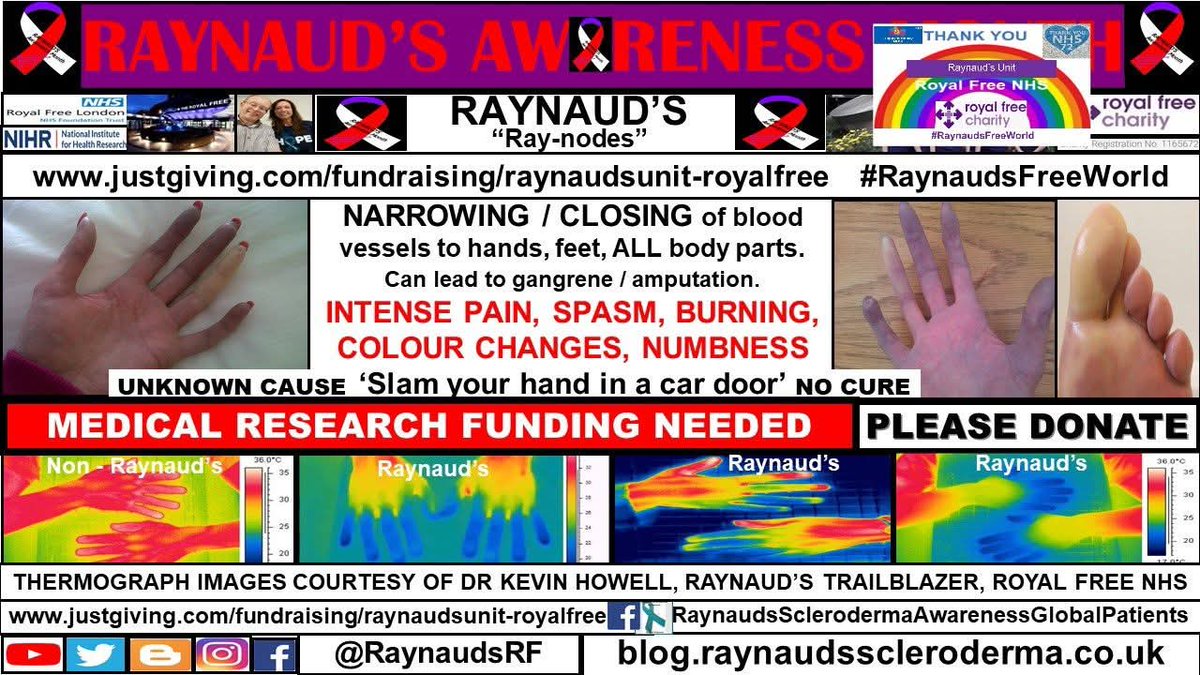 RaynaudsRf's tweet image. October #RaynaudsAwarenessMonth
raynaudsrf.blogspot.com/2019/10/the-ra…
#RaynaudsFreeWorld #Research #Raynauds
blog.raynaudsscleroderma.co.uk/2018/10/raynau…
donate here:
justgiving.com/fundraising/ra…
#Vasospasm #BlueFingers #BlueToes #Pain #DigitalUlcers #Gangrene #Amputation #NoCure
