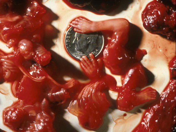 chicago_aha's tweet photo. Those who criticize the use of graphic imagery care more about having to see the image than they do about the child in the image.

#AbolishAbortion #Ephesians511 https://t.co/T1vJUUWFy9