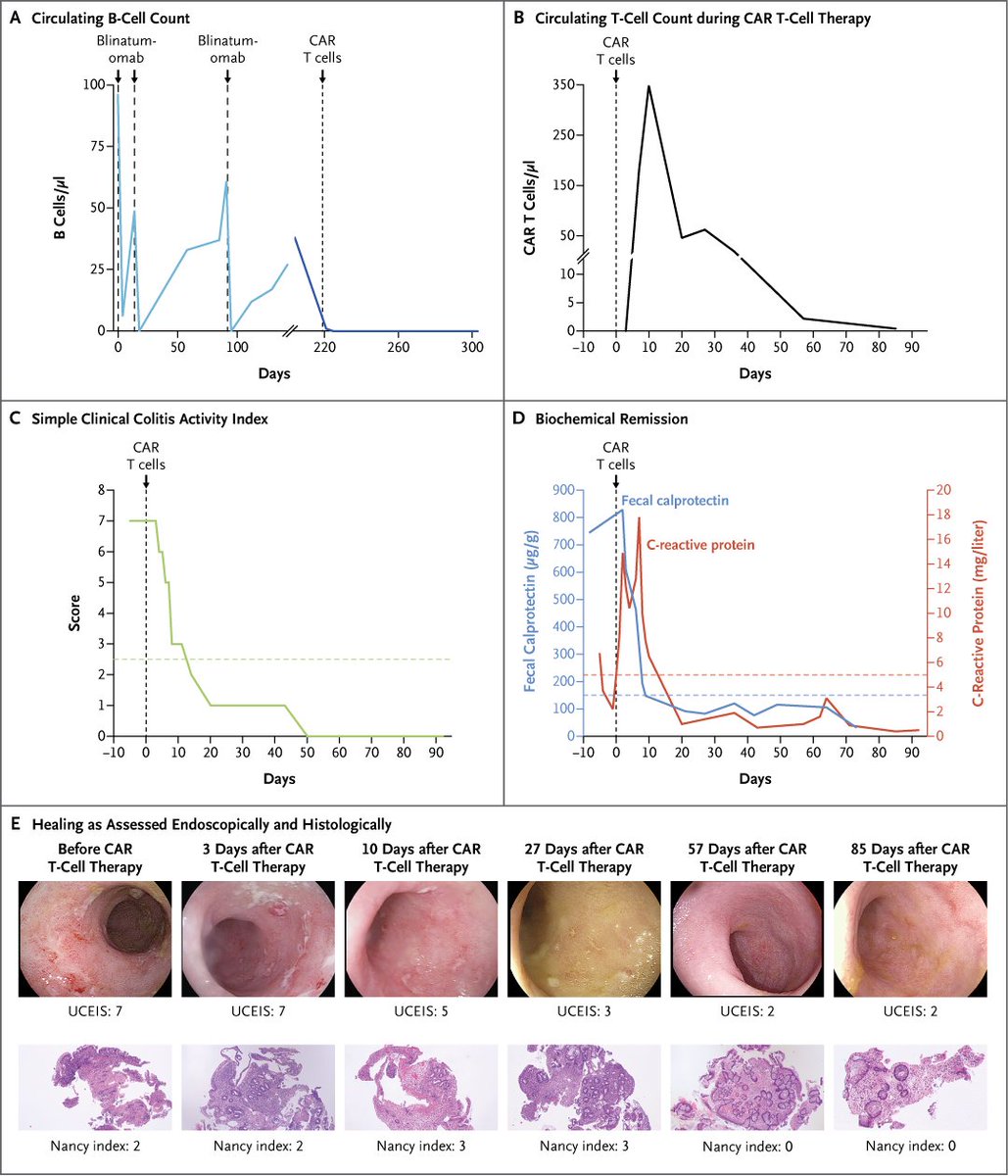 NEJM's tweet photo. Correspondence: CD19 CAR T-Cell Therapy in Multidrug-Resistant Ulcerative Colitis https://t.co/qNxDzOO2Sm 

#Gastroenterology https://t.co/qJiAQEF1LQ