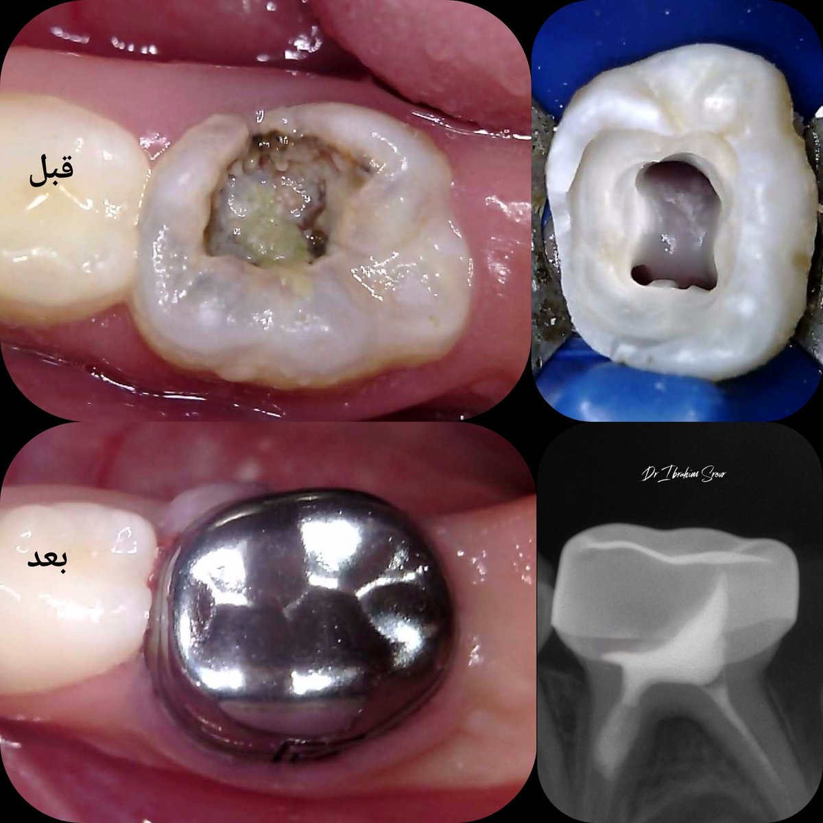 💗  Pulpectomy   for   [lower E]
 with St.St crowns in a single visit ♥️

#dr_srour