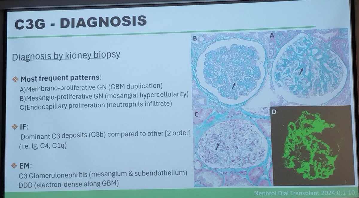 Romina Escalante (@romisoleecc) on Twitter photo Jornadas RenHerCat 2025 - Sociedad Catalana de Nefrología
Més enllà del microscopi: el paper de la genètica i el complement en la malatia glomerular - Dr. Miquel Blasco
<a href="/nefrocat/">Societat Catalana de Nefrologia</a> <a href="/SENefrologia/">S.E.N. Nefrología</a> <a href="/SJDNefrologia/">SJDNefrologia</a> <a href="/ESPNSociety/">ESPN</a> <a href="/IPNA_PedNeph/">IPNA Ped Nephrology</a> <a href="/Alanepe1/">Alanepe</a> Jornadas RenHerCat 2025 - Sociedad Catalana de Nefrología
Més enllà del microscopi: el paper de la genètica i el complement en la malatia glomerular - Dr. Miquel Blasco
<a href="/nefrocat/">Societat Catalana de Nefrologia</a> <a href="/SENefrologia/">S.E.N. Nefrología</a> <a href="/SJDNefrologia/">SJDNefrologia</a> <a href="/ESPNSociety/">ESPN</a> <a href="/IPNA_PedNeph/">IPNA Ped Nephrology</a> <a href="/Alanepe1/">Alanepe</a>