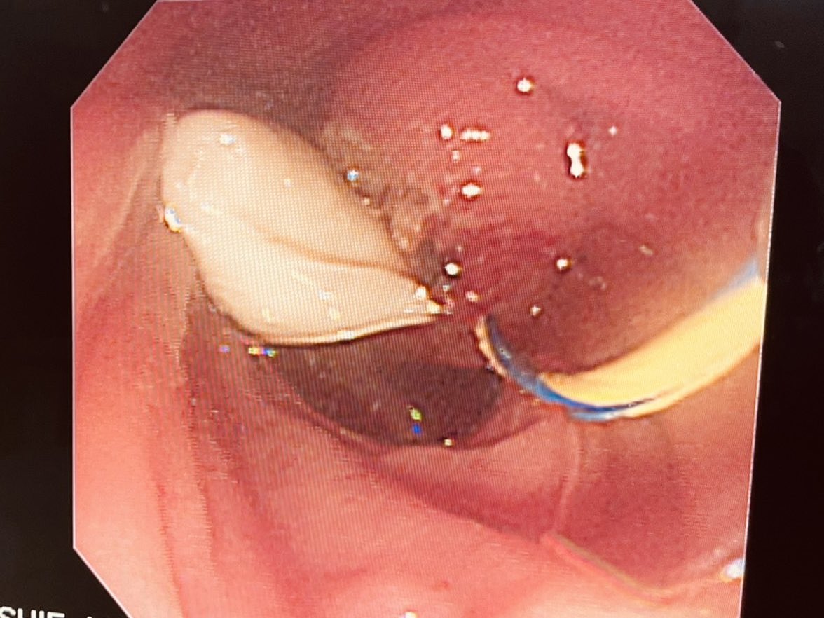 kmalik2009's tweet photo. Retrieving hydatid cyst by Ercp https://t.co/GZXaUm2lET