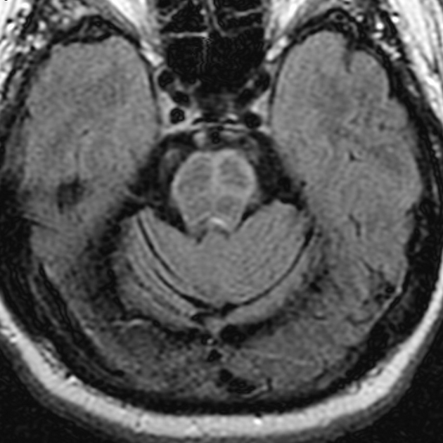 #NeuroradiologySign

Hot Cross Bun Sign❌🫓 – Pontine Atrophy in MSA

Modality: Axial T2 MRI

Appearance:
Cruciform T2 hyperintensity in the pons from selective degeneration of transverse pontocerebellar and longitudinal pontine fibers → resembles a hot cross bun

#NeuroTwitter