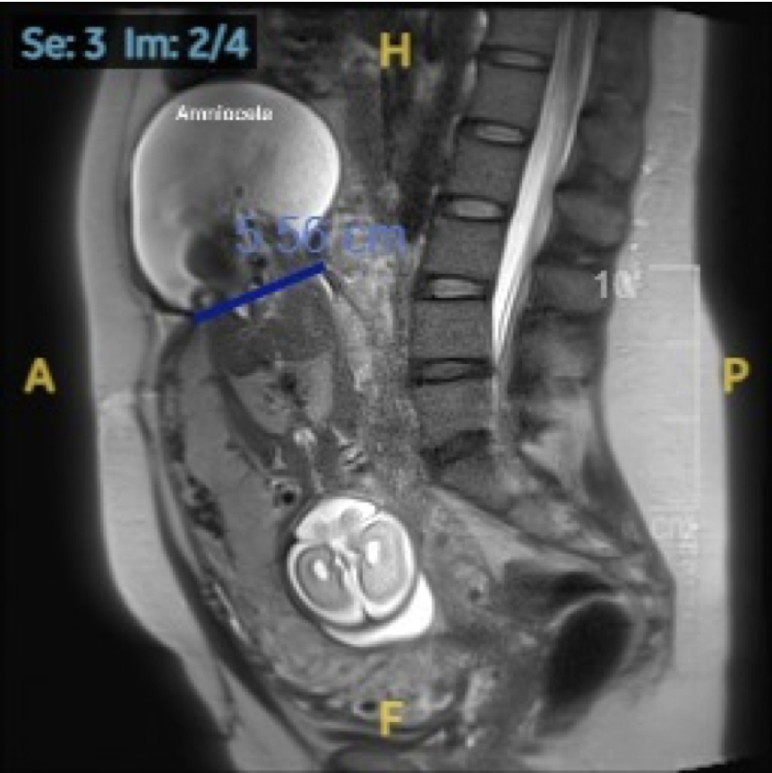 AJOG_thegray's tweet photo. Images in Obstetrics: Spontaneous uterine rupture at 23 weeks’ gestation after prior myomectomy https://t.co/OUA1xKn8Tg #ultrasound #obgyn #pregnancy @ACOG @ISUOG @AIUM @RCOG https://t.co/birzI27p04