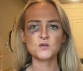 This is <a href="/KatieDaviscourt/">Katie Daviscourt 📸</a> a Seattle journalist.

The Democrats tried to silence her like they did Charlie Kirk.

Last night Portland ANTIFA attacked her and bashed her in the face with a flag pole.

The left will kill you if you oppose them loud enough.

God Bless Katie and the