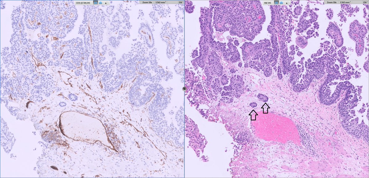 slusagar's tweet photo. in #GUpath TURBT, areas suspicious for LVI are:

1) a great clue🧐for lamina propria invasion (stromal retraction)
2) infrequently represent actual LVI (CD31 #IHCpath shown here; not LVI) https://t.co/ZEQbKM73s2