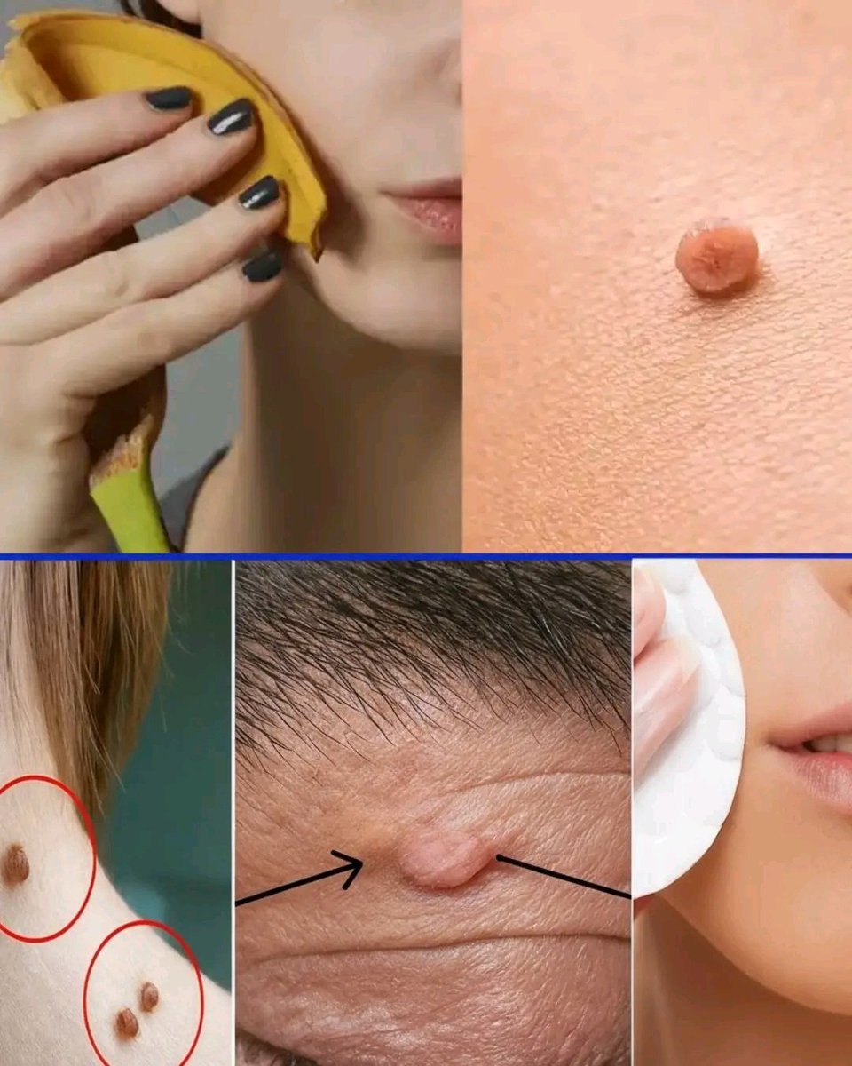 🍌✨ Remove Skin Tags Naturally! 🌿💚
🌿 Softens &amp; dries out skin tags
🌿 Gentle &amp; non-invasive method
🌿 Simple, safe &amp; effective at home

✅ Clean area → Place inner side of banana peel on tag → Secure overnight with bandage. Repeat daily until it falls off (1–3 weeks).