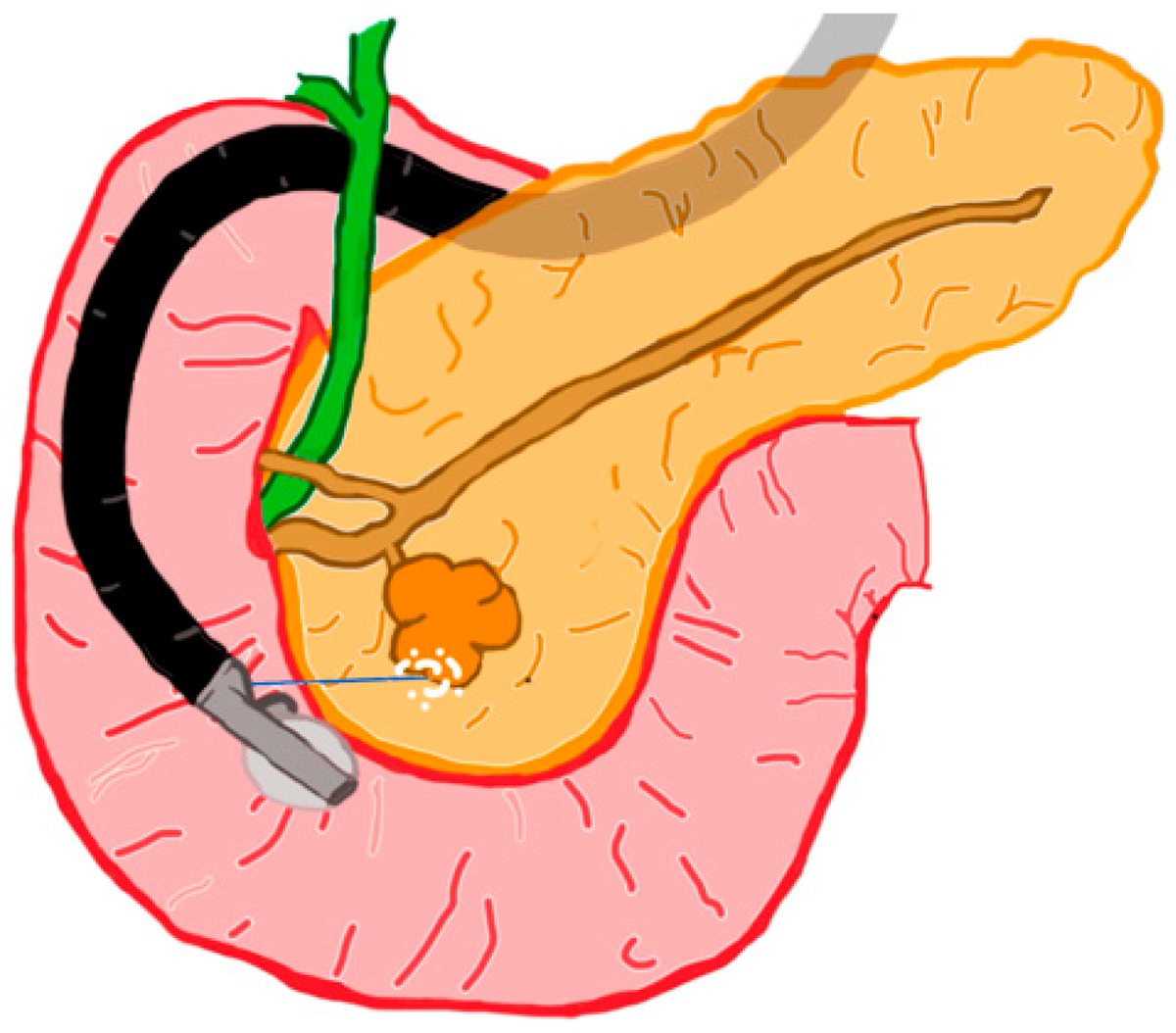 diagnostic_mdpi's tweet image. #highlycitedpaper #EUS
"A Review on Endoscopic Ultrasound-Guided Radiofrequency Ablation (EUS-RFA) of Pancreatic Lesions"
✍️by Fred G. Karaisz et al. @som_krishna
📖Full paper available at mdpi.com/2075-4418/13/3…