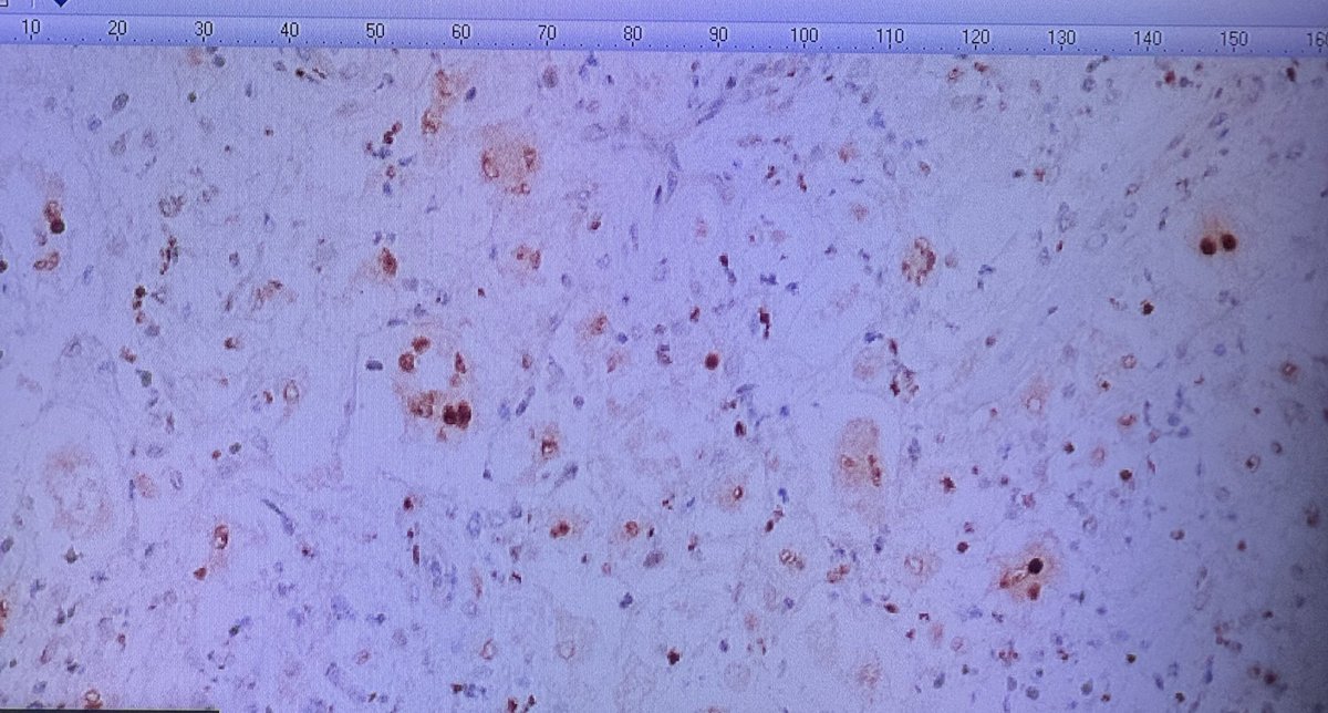 Esta semana retomamos las sesiones dermatopatológicas en <a href="/dermah12o/">Dermatología Hospital 12 Octubre</a> 
🔬 H&amp;E, S100, OCT-2
⬇️