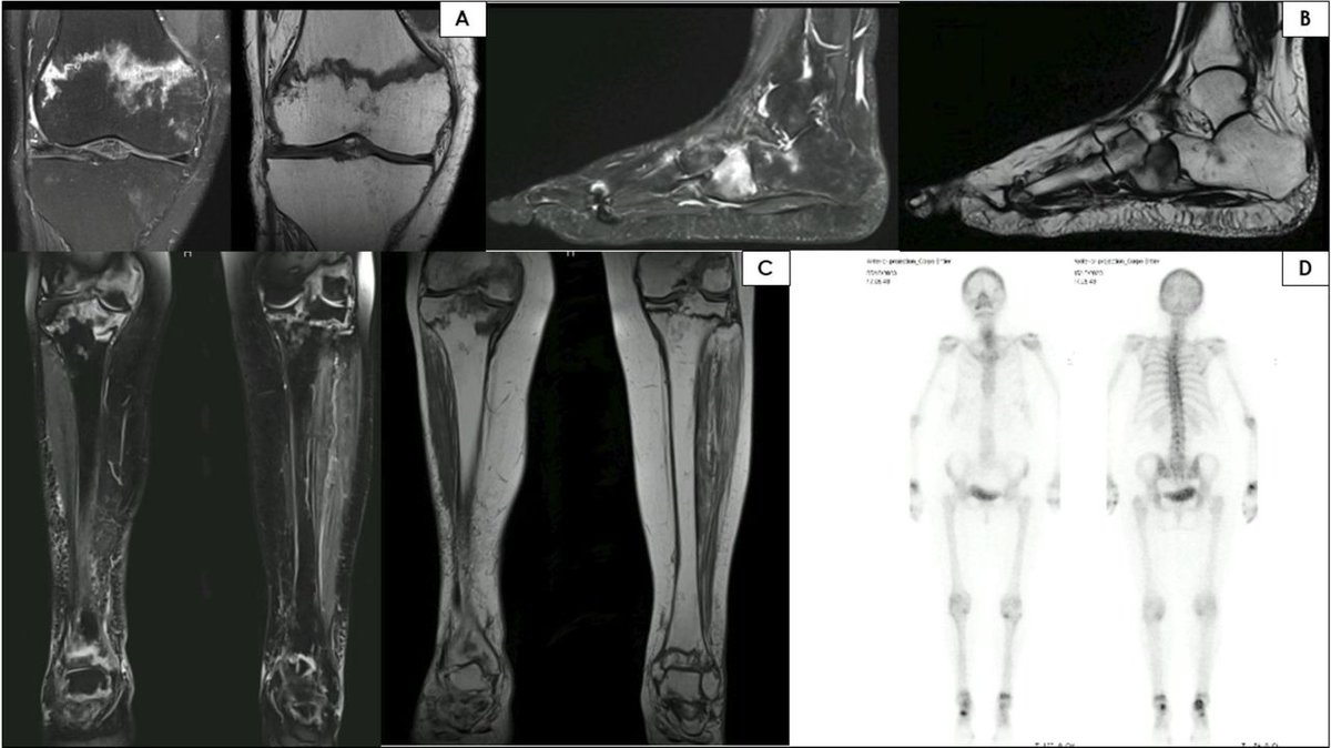 bmj_rmdopen's tweet photo. 💊 Methotrexate osteopathy: rare but serious complication causing stress fractures in lower limbs (88% tibia, 49% foot) among RA/PsA patients—often multiple & recurrent
📊 92-patient cohort shows MTX continuation = disaster: 71% poor outcomes vs 9% with MTX stop. Healing achieved in 91% who discontinued vs only 29% who continued (p<0.001)
⚠️ Early MRI/scintigraphy diagnosis essential—stopping MTX is critical for fracture healing & preventing recurrence. Duration/dose didn't predict outcomes, only continuation/discontinuation mattered

🔗 https://t.co/rd0exiYSeS