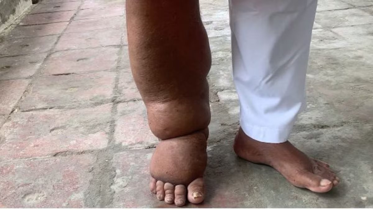 Gwanda residents will receive free de-worming tablets from October 13 to 23, 2025, as part of a mass drug administration campaign to combat elephantiasis (lymphatic filariasis).