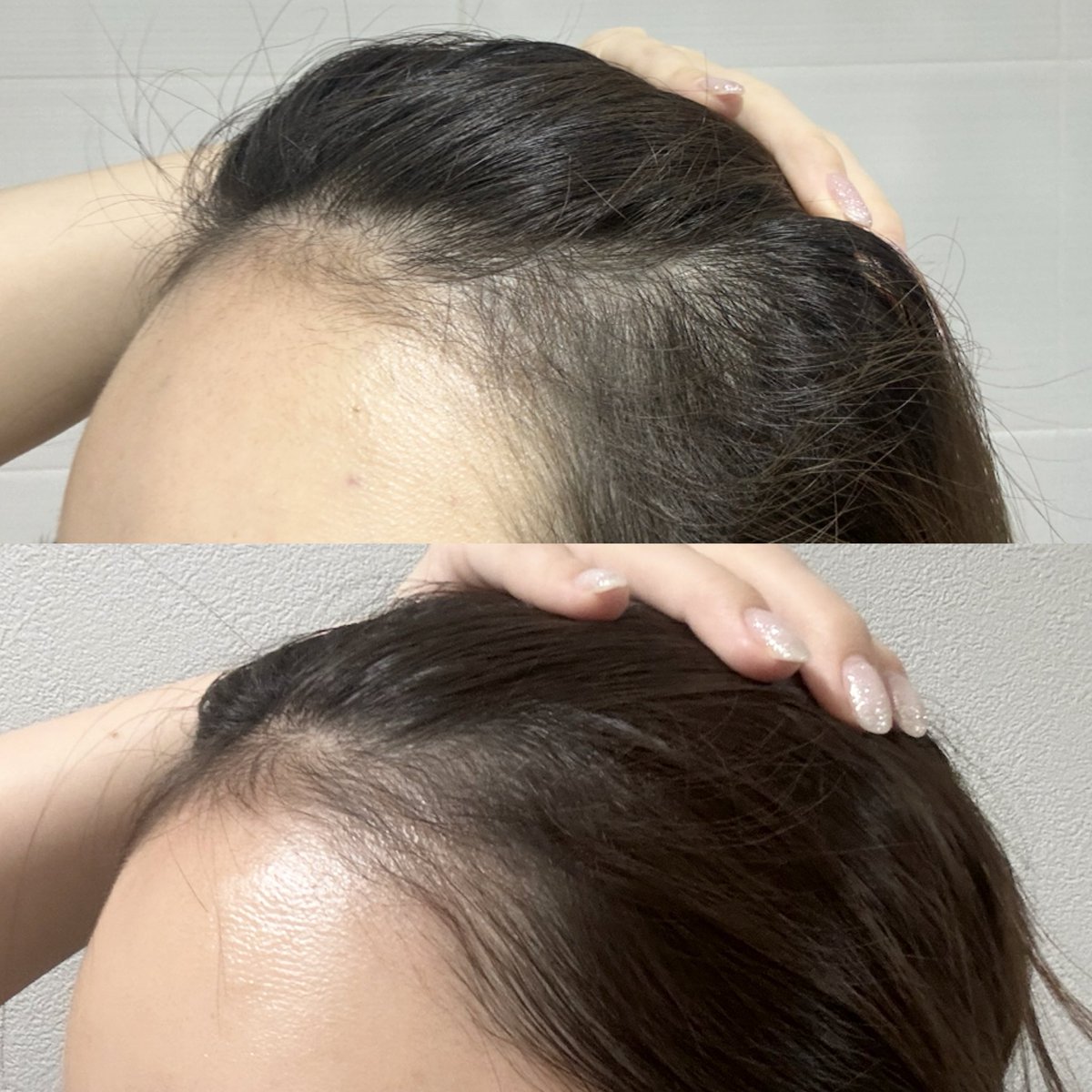 khsr02's tweet photo. 韓国薬局で買った育毛スプレーを約2ヶ月毎日生え際に塗ってみたんだけど効果凄くない⁉️明らかにフサフサになったしおでこ綺麗に見えるようになった🥹

(上がビフォー、下がアフター) https://t.co/XcShbupqOB