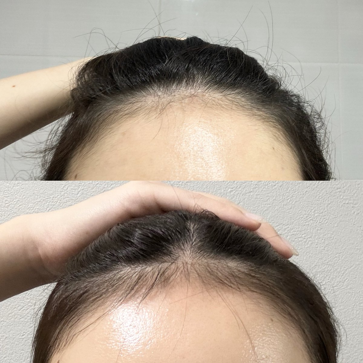 khsr02's tweet photo. 韓国薬局で買った育毛スプレーを約2ヶ月毎日生え際に塗ってみたんだけど効果凄くない⁉️明らかにフサフサになったしおでこ綺麗に見えるようになった🥹

(上がビフォー、下がアフター) https://t.co/XcShbupqOB