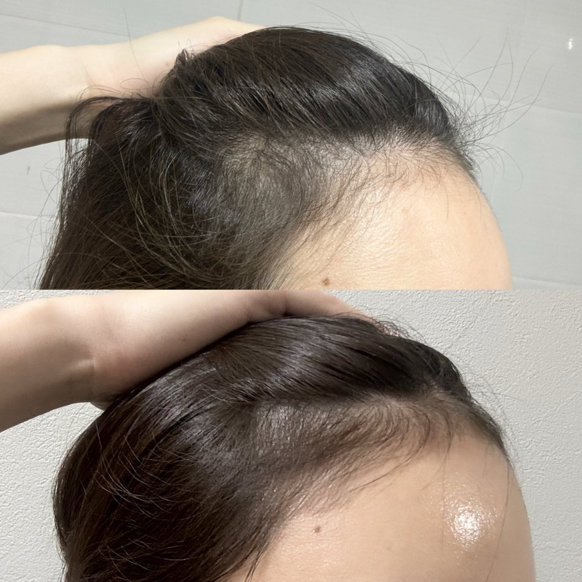 khsr02's tweet photo. 韓国薬局で買った育毛スプレーを約2ヶ月毎日生え際に塗ってみたんだけど効果凄くない⁉️明らかにフサフサになったしおでこ綺麗に見えるようになった🥹

(上がビフォー、下がアフター) https://t.co/XcShbupqOB
