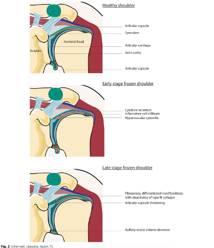 🧊FISIOPATOLOGÍA DEL HOMBRO CONGELADO🧊