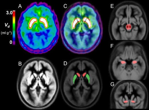 sanilrege's tweet photo. 🧵How neurobiology connects to clinical practice in psychosis 🚨1/9 

A recent 18F-DOPA PET Study
shows why psychotic depression and schizophreniform psychosis require  such different treatment strategies. 

The study concluded:
“Dopamine function differed across psychotic disorders when different mood states were present, particularly in the limbic striatum. Transdiagnostically, positive psychotic symptoms were associated with dopamine synthesis capacity in the associative striatum.”
( Jauhar et al,2025) 

This matters for how we treat.

Let’s link phenomenology → striatal neurobiology → pharmacology. 👇