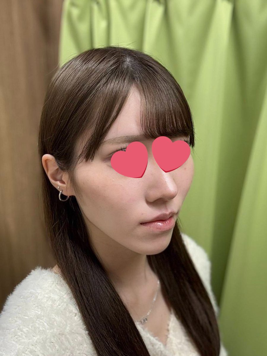 nian165's tweet photo. 🩷DA美容外科(@daprsjp)さん🩷
で輪郭3点手術をして今日で3️⃣ヶ月が経過したのでご報告です💉◝✩˚

術前⬅️➡️術後(3ヶ月目)
(全て無加工ポートレートです！加工🆖)

2ヶ月目と比べるとかなり腫れが引いてきて、フェイスラインがシュッとして綺麗になってきました!!✨️
来月の経過も楽しみです☺️🌸 https://t.co/5cvpu3LxDl