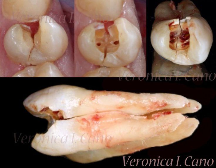 OdontologosCol's tweet photo. 😱 Fractura de dientes vertical completa por abrir una botella de cerveza con los dientes https://t.co/8yKeQykzRp