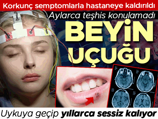 Hurriyet's tweet photo. Beyinde uçuk mu olur? 'Uykuya geçip yıllarca sessiz kalabiliyor' Her uçuk çıkaranda aynı risk var mı?

🖊️@batisedef haberi...

https://t.co/4YoerIzbph https://t.co/P19r0ZYTY8