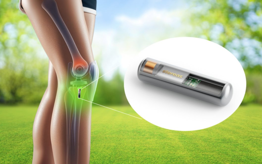 Ilikaplc's tweet image. In this Use Case - Miniature Solid State Batteries for Smart Orthopedics - we look at the benefits of incorporating #sensors into prosthetic implants & how #Stereax #solidstatebatteries can provide the power required. ilika.com/battery-techno… #medtech #batteries #medicalimplants