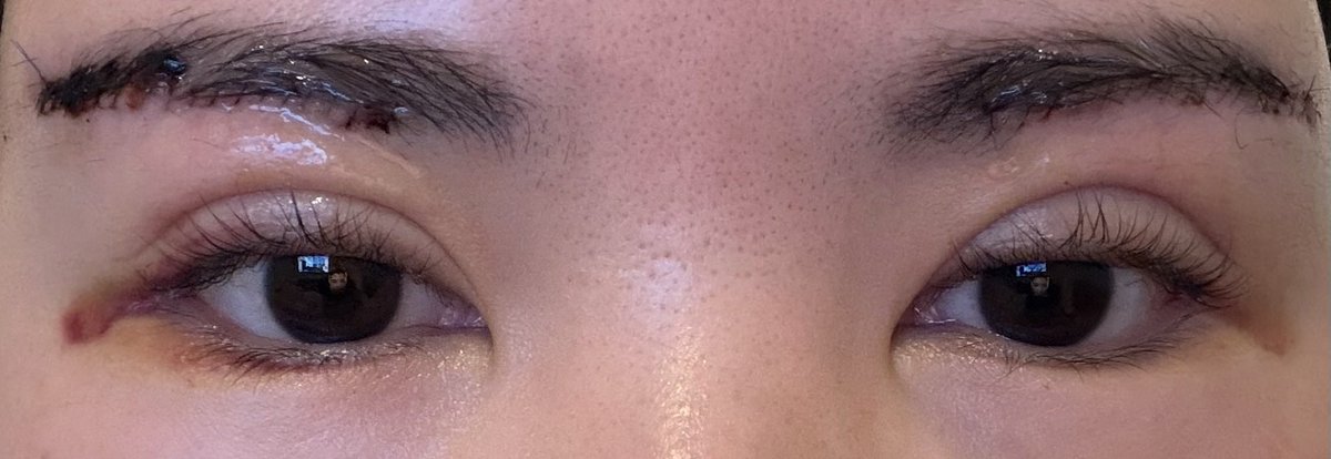 眉下切開、タレ目形成dt4日目
腫れがピークであります👀
目尻の青あざ目立つ