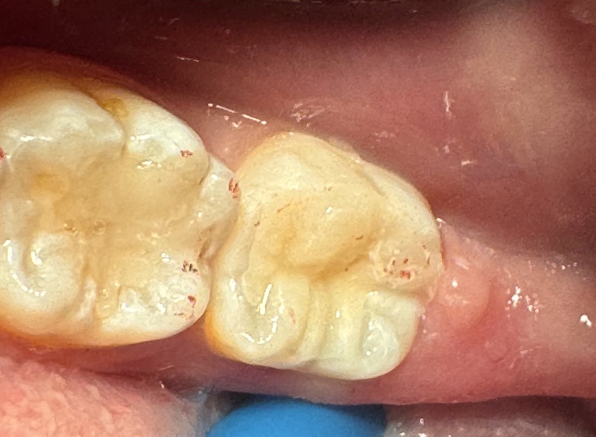 Kick of the Day! 🔥
Tooth #47 with occlusal caries (sadly no pre-operative photo)
Tooth restored with composite restoration using stamp technique 🧩

Impressed with the result ✨
