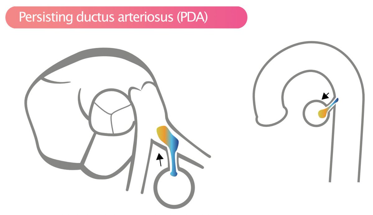 PDA is best seen with color Doppler in suprasternal view or short-axis view (SAX).

cardvasc.org/congenital-hea…