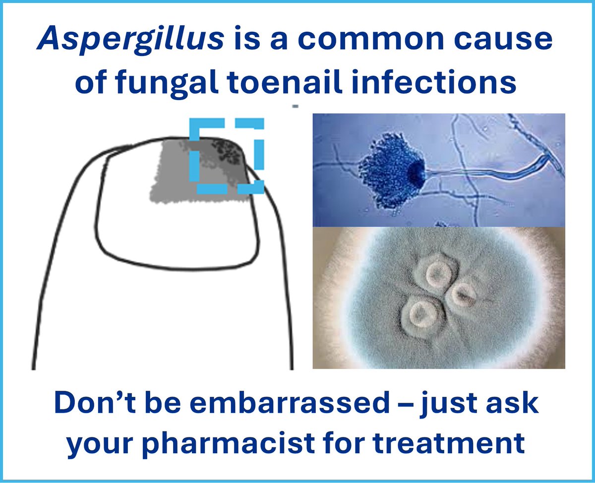 Today is #UKFungusDay 🍄

Aspergillus is a common culprit in fungal toenail infections – fortunately it is treatable!

Talk to your pharmacist if your nail starts growing thicker and turns yellow/white, especially if you are diabetic or immunosuppressed

nhs.uk/conditions/fun…