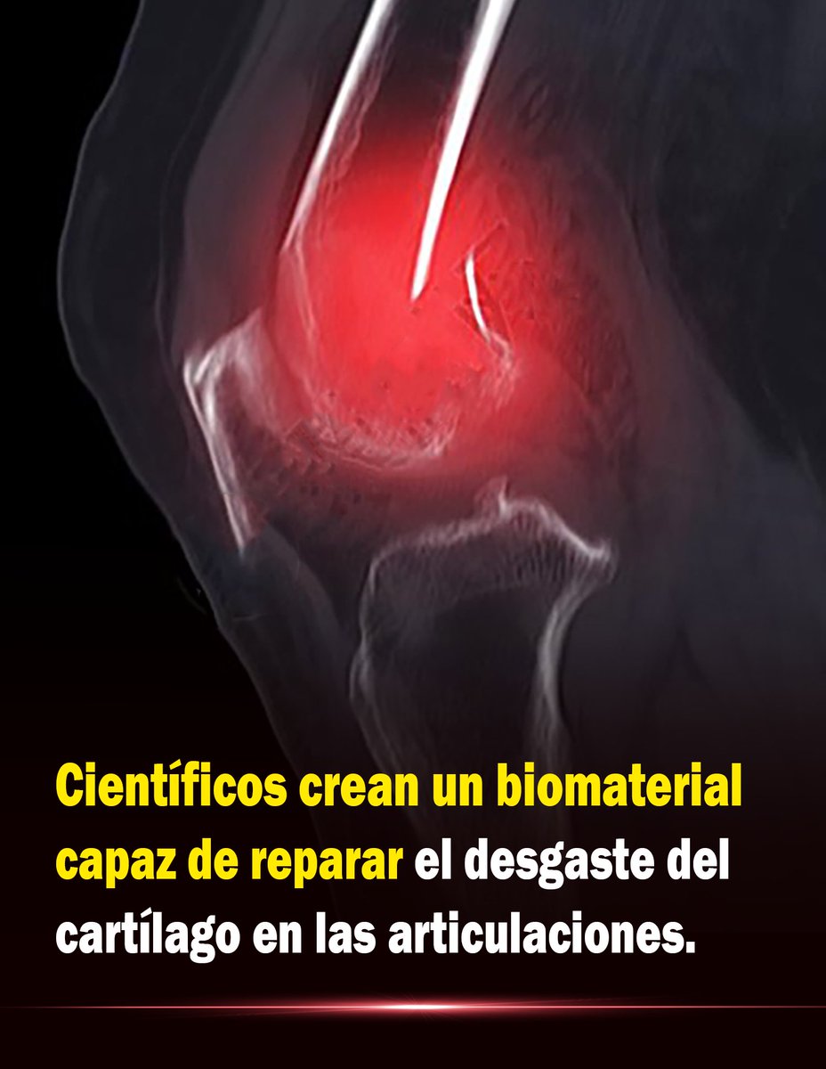 Bio_comunidad's tweet photo. Un avance que podría cambiar la ortopedia: crean un biomaterial innovador capaz de reparar el cartílago dañado y frenar el desgaste que provoca dolor y discapacidad. 👇 https://t.co/K1rM2KLNxP
