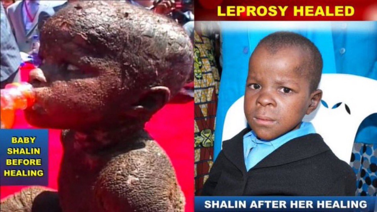 linetmutoro14's tweet image. Leprosy healed.
#EndTimePower