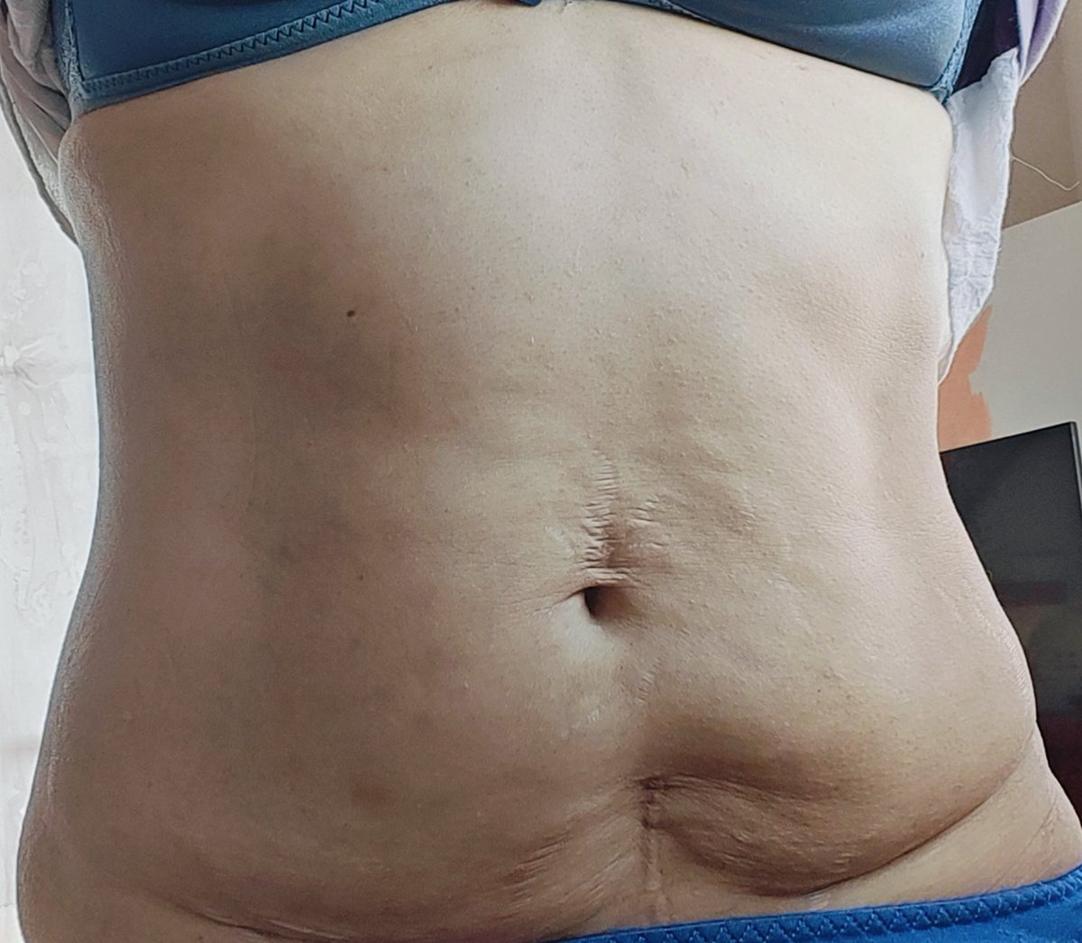 毎日 #プランク 頑張って、 #脂肪冷却 も #マンジャロ も #椅子ストレッチ  も頑張ってる！#ダイエット一ヶ月経過報告 ちょっと格好良くなってません？私の腹の #ガチャピン プランク辛いけどお腹の奥が熱くなってるのが #脂肪燃えてる ！って感じて堪らない！！今月も頑張るぞ！